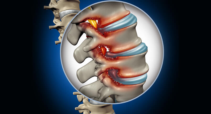 blog-spinal-stenosis-1.jpg